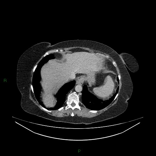 Cerebral metastasis from renal cell carcinoma (Radiopaedia 82306-96378 A 23).jpg