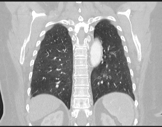 Cerebral metastasis to basal ganglia (Radiopaedia 81568-95414 Coronal lung window 64).png