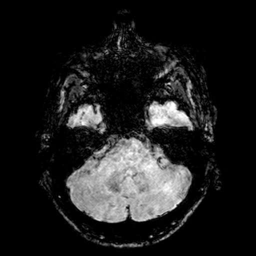 Cerebral parenchymal arteriovenous malformation (Radiopaedia 27280-27456 Axial SWI 17).jpg