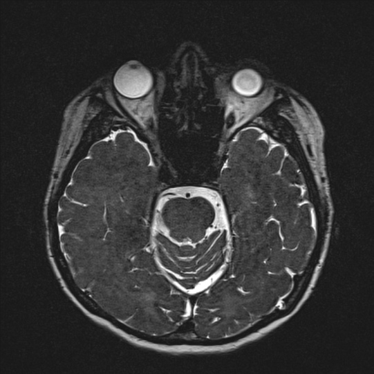 Cerebral ring enhancing lesions - cerebral metastases (Radiopaedia 44922-48817 F 60).jpg