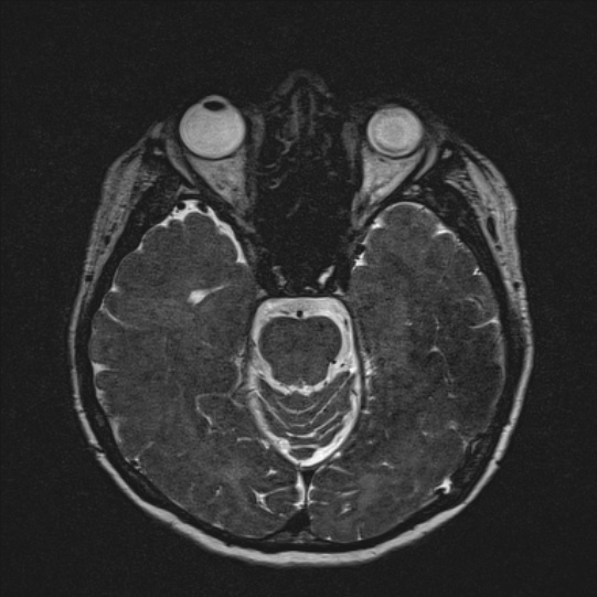 Cerebral ring enhancing lesions - cerebral metastases (Radiopaedia 44922-48817 F 64).jpg