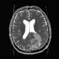 File:Cerebral toxoplasmosis (Radiopaedia 43956-47461 Axial ADC 12).jpg