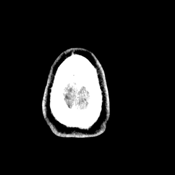 Cerebral toxoplasmosis (Radiopaedia 53993-60131 Axial non-contrast 74).jpg
