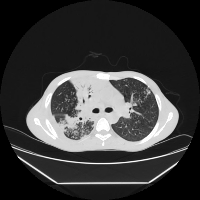 File:Cerebral tuberculoma (Radiopaedia 80829-94318 Axial lung window 66).jpg