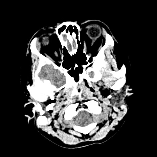 Cerebral tuberculosis with dural sinus invasion (Radiopaedia 60353-68018 Axial non-contrast 4).jpg