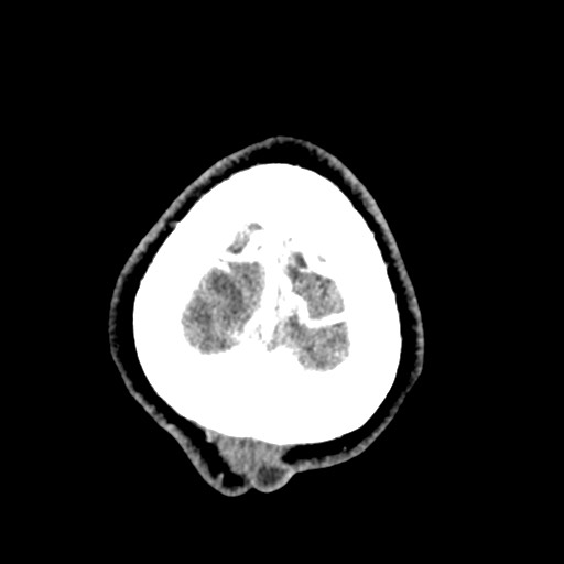 Cerebral tuberculosis with dural sinus invasion (Radiopaedia 60353-68019 Axial C+ delayed 64).jpg