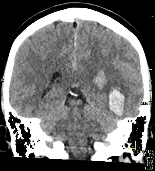 Cerebral venous sinus thrombosis (Radiopaedia 91329-108965 Coronal non-contrast 37).jpg