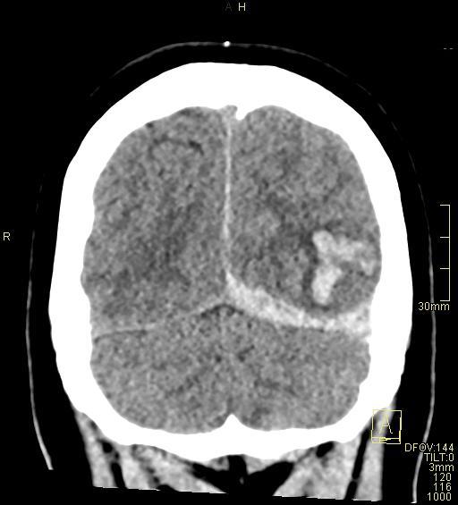 File:Cerebral venous sinus thrombosis (Radiopaedia 91329-108965 Coronal non-contrast 48).jpg