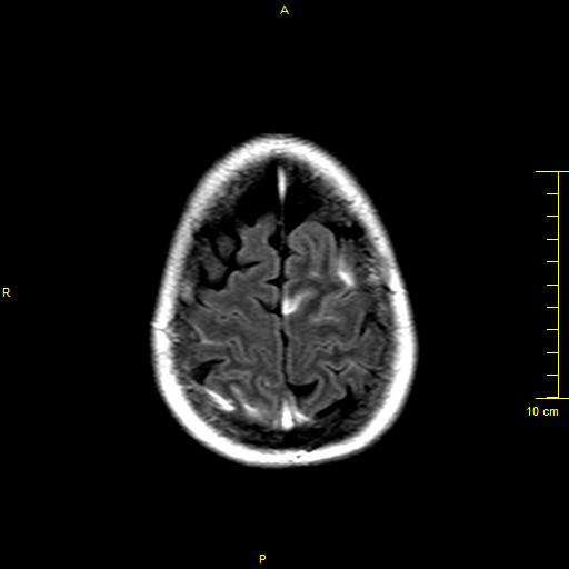 File:Cerebral venous thrombosis (Radiopaedia 23288-23351 Axial FLAIR 19).JPG