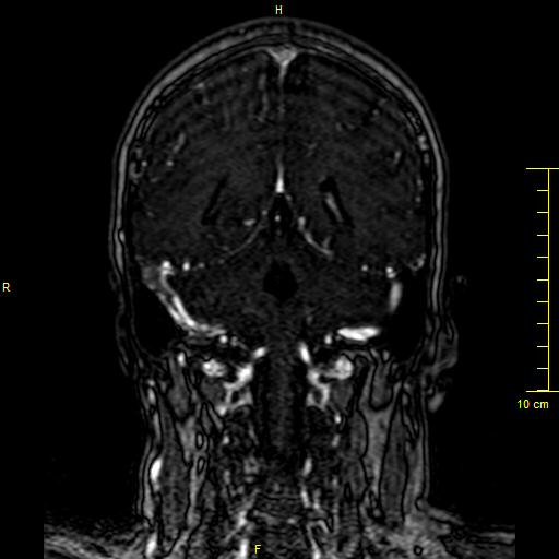 Cerebral venous thrombosis (Radiopaedia 23288-23351 MRV 111).JPG