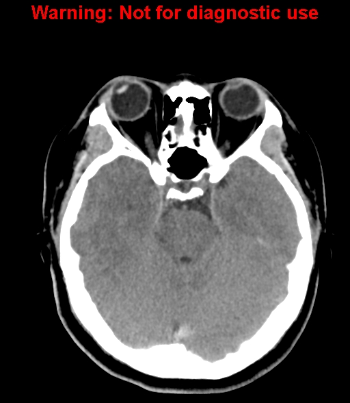 File:Cerebral venous thrombosis (Radiopaedia 37224-38992 Axial non-contrast 10).jpg