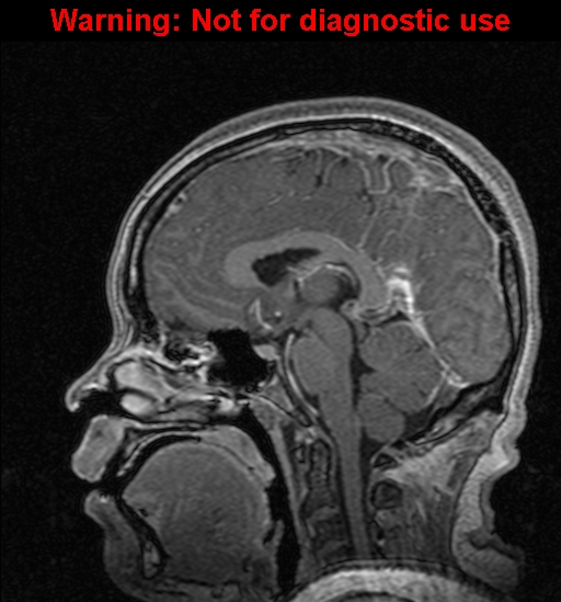 Cerebral venous thrombosis (Radiopaedia 37224-39208 Sagittal T1 C+ 78).jpg