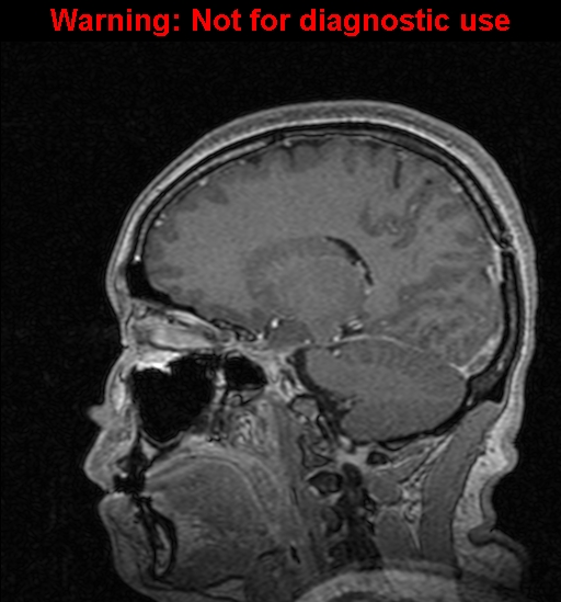 Cerebral venous thrombosis (Radiopaedia 37224-39208 Sagittal T1 C+ 91).jpg