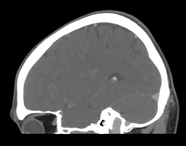 Cerebral venous thrombosis (Radiopaedia 38392-40467 D 16).png