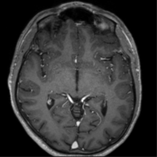 Cerebral venous thrombosis (Radiopaedia 38392-40469 Axial T1 C+ 38).png