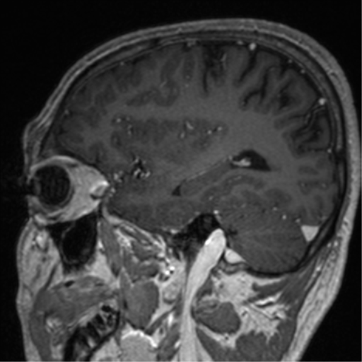 Cerebral venous thrombosis (Radiopaedia 38392-40469 Sagittal T1 C+ 29).png