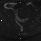 Cervical adenocarcinoma (Radiopaedia 65011-73985 Axial DWI 66).jpg
