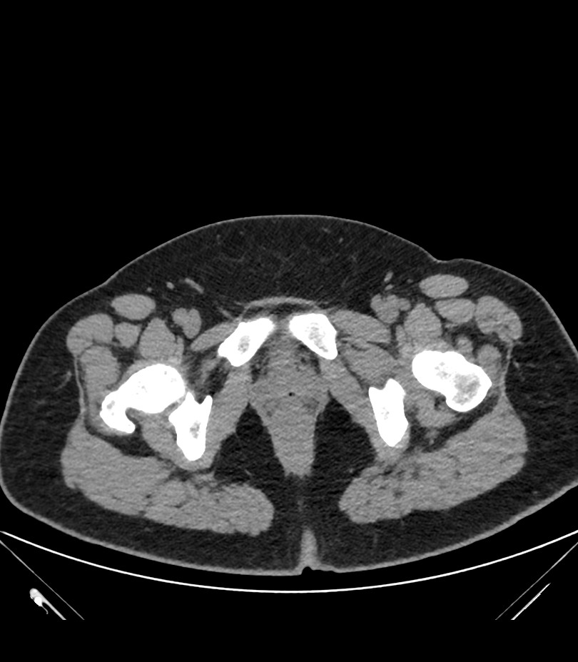 Cervical aortic arch with coarctation and aneurysms (Radiopaedia 44035-47552 Axial non-contrast 98).jpg