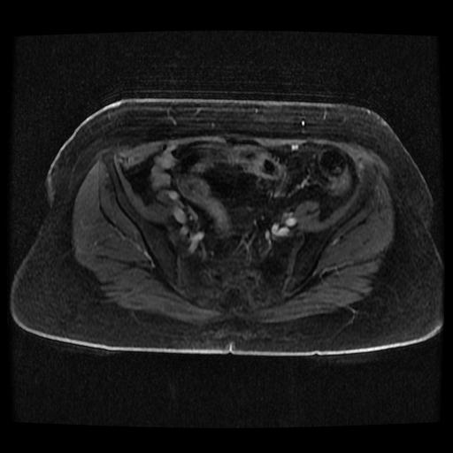 Cervical carcinoma (Radiopaedia 70924-81132 Axial T1 C+ fat sat 154).jpg
