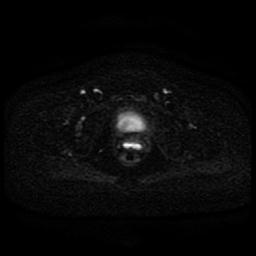 Cervical carcinoma (Radiopaedia 85405-101028 Axial DWI 25).jpg