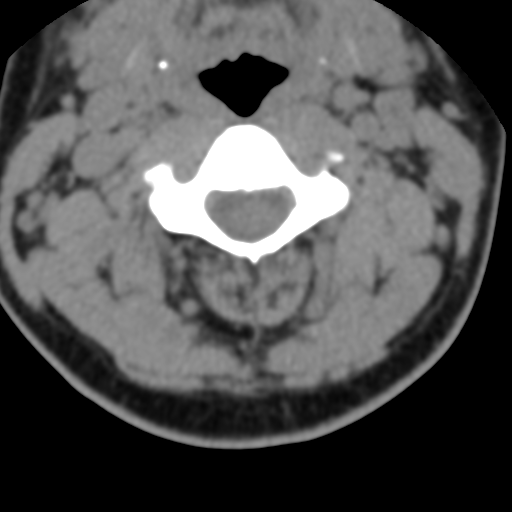 File:Cervical schwannoma (Radiopaedia 57979-64974 Axial non-contrast 26).png