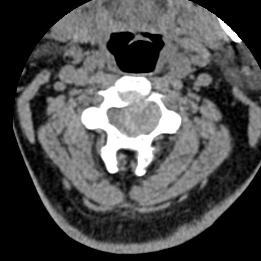 File:Cervical spinal neurofibroma in a patient with NF1 (Radiopaedia 58344-65464 Axial non-contrast 28).jpg