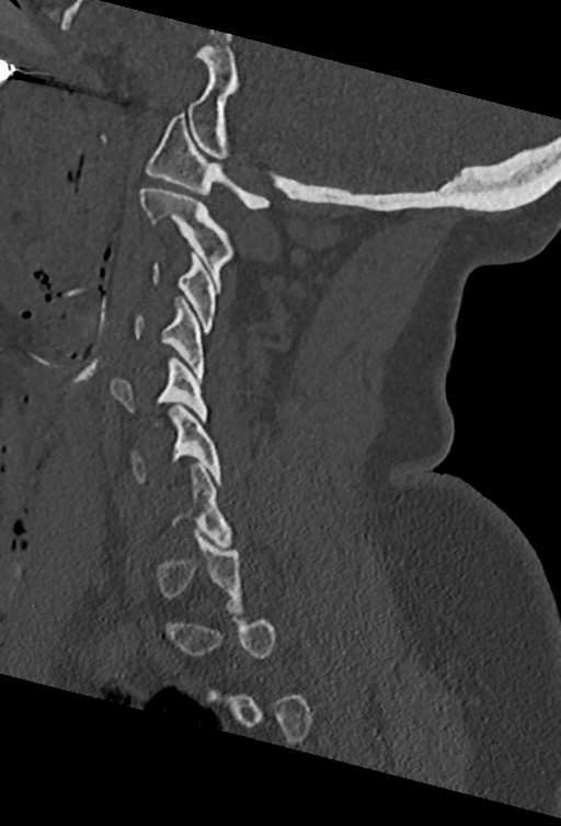 Cervical spine ACDF loosening (Radiopaedia 48998-54070 Sagittal bone window 33).png
