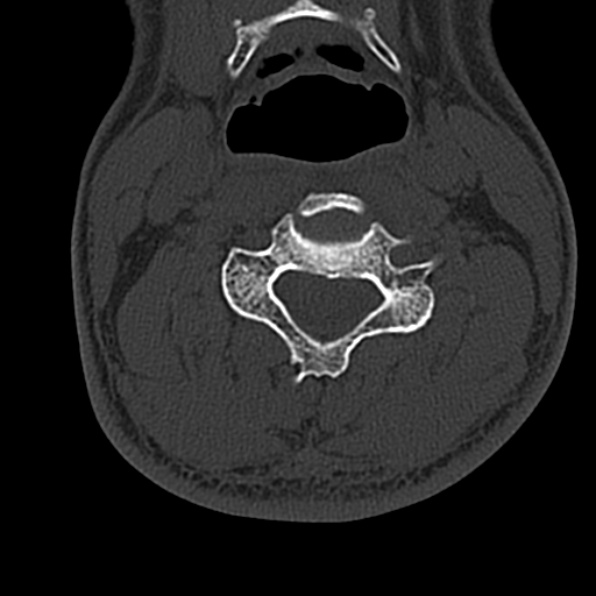 Cervical spondylodiscitis (Radiopaedia 28057-29489 Axial bone window 39).jpg