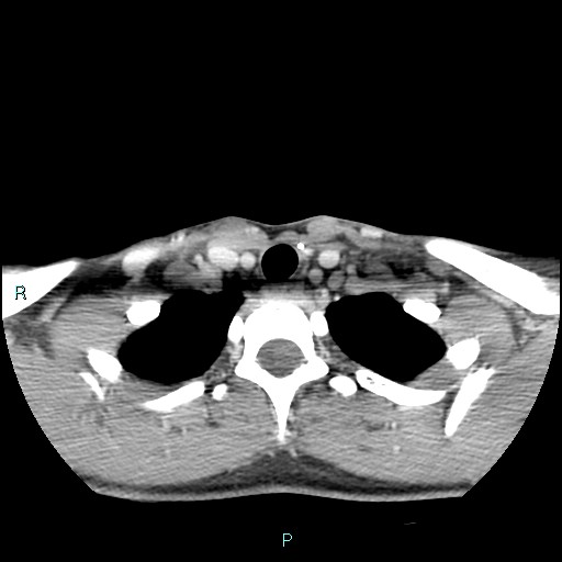 Cervical thymic cyst (Radiopaedia 88632-105335 C 31).jpg