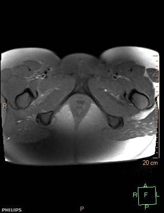File:Cesarian scar endometriosis (Radiopaedia 68495-78066 Axial T1 fat sat 26).jpg