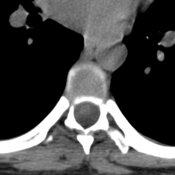Chance fracture (Radiopaedia 36521-38081 Axial non-contrast 5).jpg