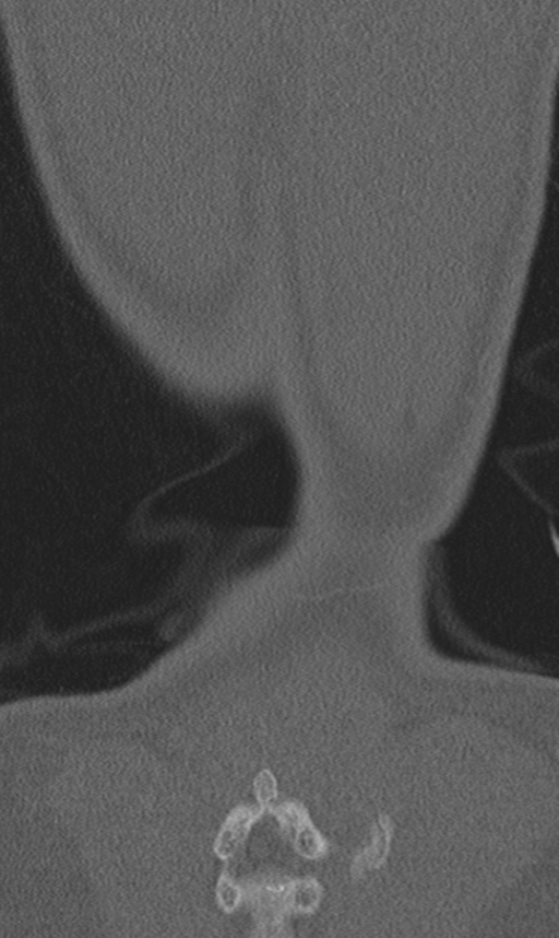 Chance fracture (Radiopaedia 40360-42912 Coronal bone window 71).png