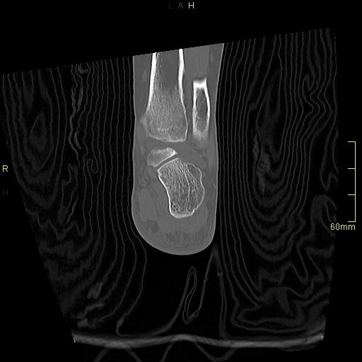 Chaput tubercle fracture (Radiopaedia 80319-93956 Coronal non-contrast 47).jpg