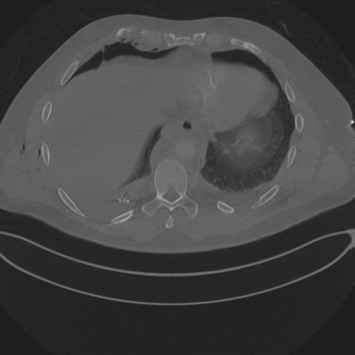 Chest multitrauma - aortic injury (Radiopaedia 34708-36147 Axial bone window 229).png