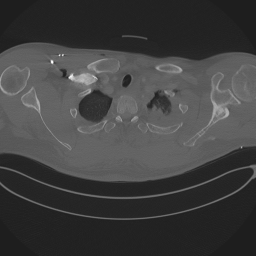 Chest multitrauma - aortic injury (Radiopaedia 34708-36147 Axial bone window 35).png