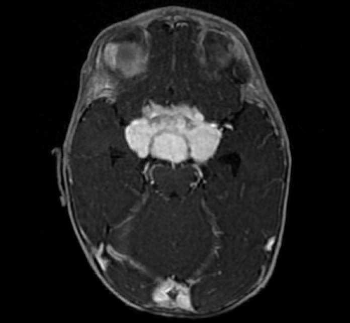 Chiasmatic-hypothalamic glioma (Radiopaedia 90079-107252 Axial T1 C+ 30).jpg