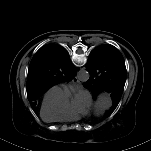 File:Cholecystitis - obstructive choledocholitiasis (CT intravenous cholangiography) (Radiopaedia 43966-47479 Axial 65).png