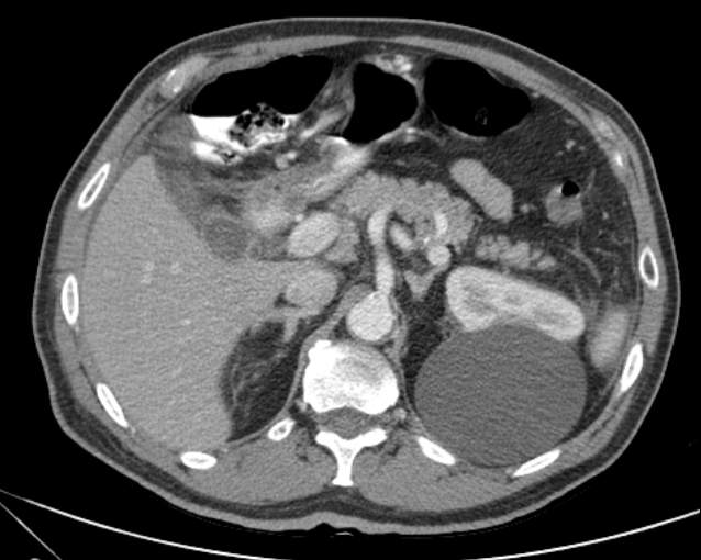 Cholecystitis - perforated gallbladder (Radiopaedia 57038-63916 A 29).jpg