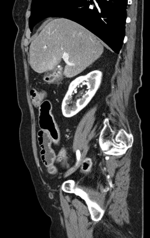 Cholecystoduodenal fistula due to calculous cholecystitis with gallstone migration (Radiopaedia 86875-103077 C 42).jpg