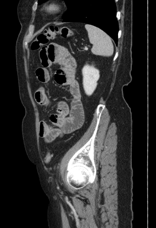 Cholecystoduodenal fistula due to calculous cholecystitis with gallstone migration (Radiopaedia 86875-103077 F 12).jpg