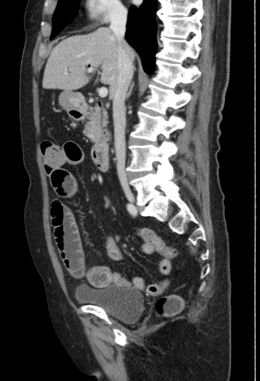 Cholecystoduodenal fistula due to calculous cholecystitis with gallstone migration (Radiopaedia 86875-103077 F 34).jpg