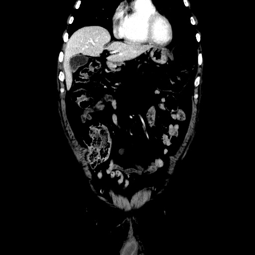 Choledocholiathiasis with normal caliber common bile duct (Radiopaedia 75368-86632 Coronal liver window 40).jpg