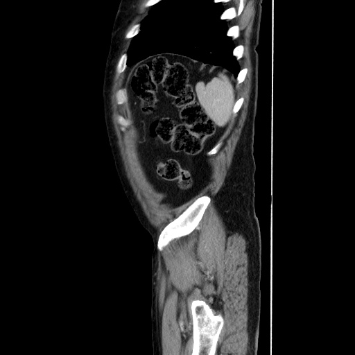 Choledocholiathiasis with normal caliber common bile duct (Radiopaedia 75368-86632 D 136).jpg