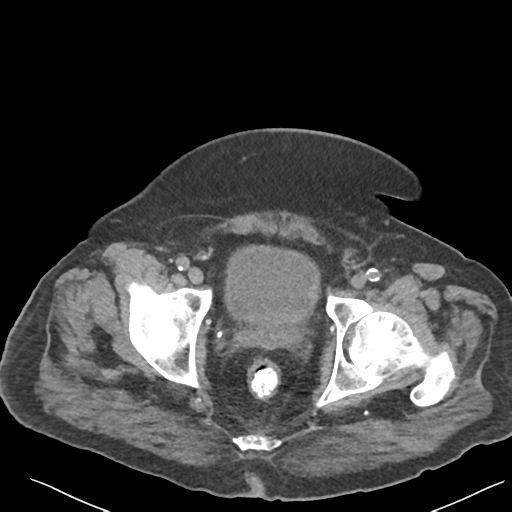 File:Choledocholithiasis and gastric polyp (Radiopaedia 48856-53895 Axial non-contrast 82).png