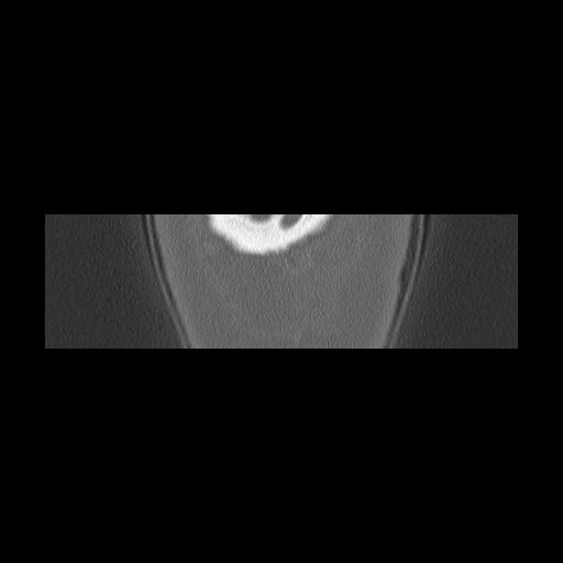 Cholesteatoma (Radiopaedia 84946-100455 Coronal bone window 171).jpg