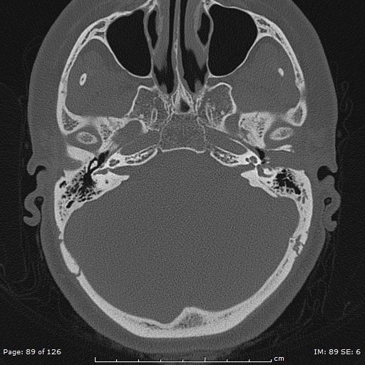 Cholesteatoma - external auditory canal (Radiopaedia 88452-105096 Axial bone window 52).jpg
