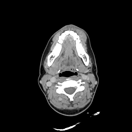File:Chondroblastic osteosarcoma (Radiopaedia 67363-76741 Axial with contrast 19).jpg