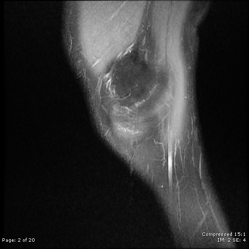 File:Chondroblastoma (Radiopaedia 25725-25891 Sagittal PD 2).jpg
