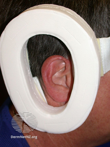 File:Chondrodermatitis nodularis helicis protector (DermNet NZ site-age-specific-ear-cnh-protector).jpg