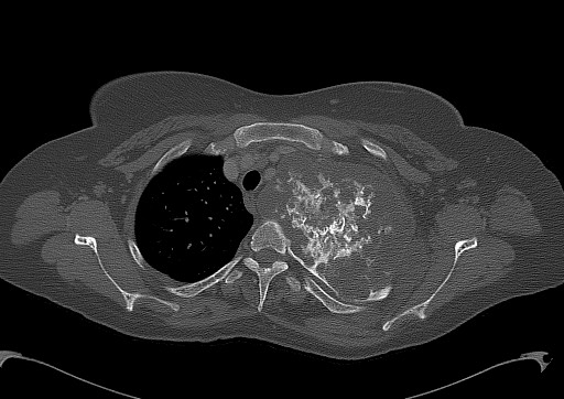 Chondrosarcoma - chest wall (Radiopaedia 65192-74199 Axial bone window 30).jpg